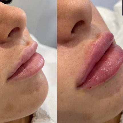 Derma Fillers